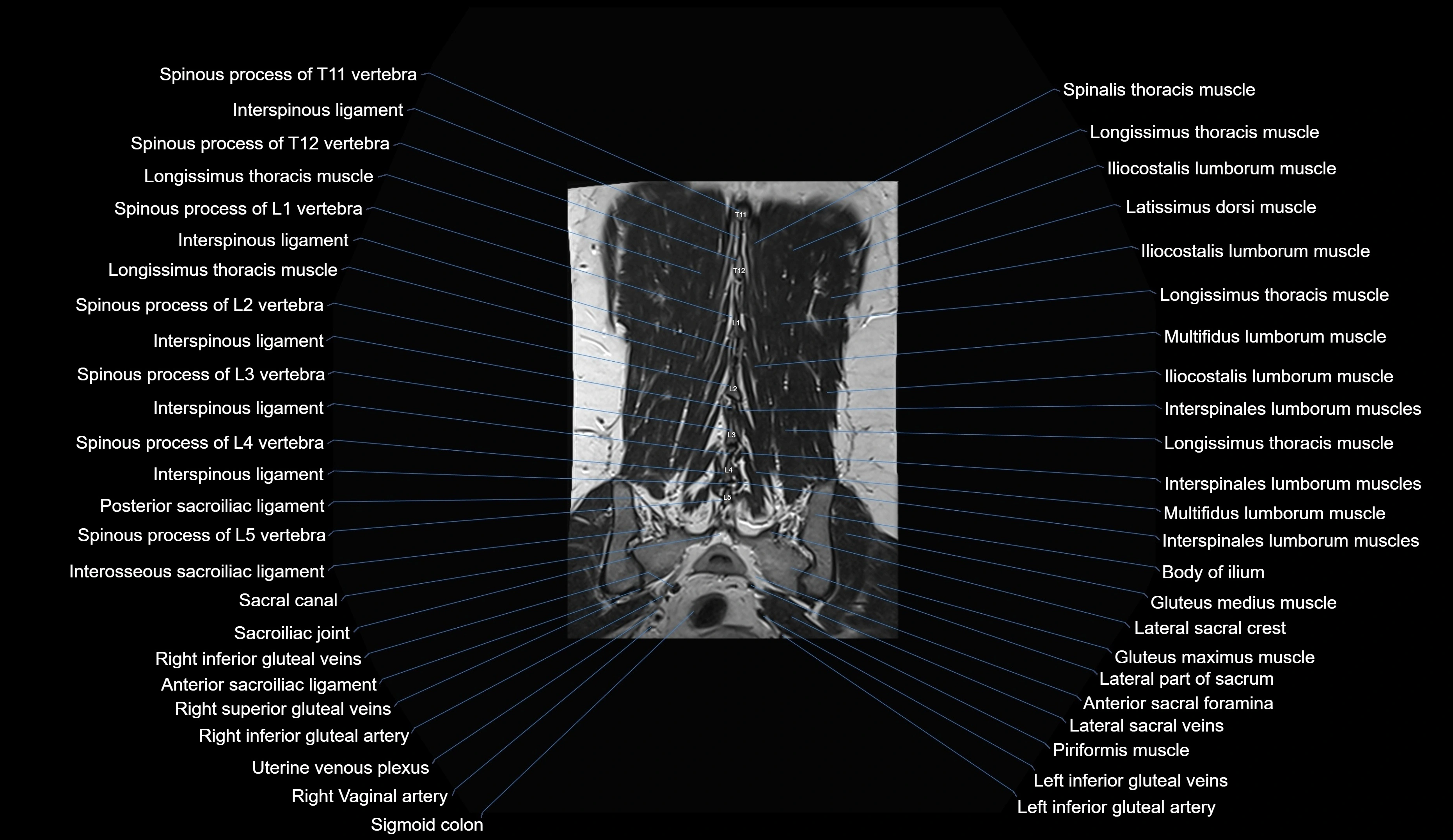 MRI lumbar spine coronal cross sectional anatomy 3T radiology  image-img-00001-00030.webp